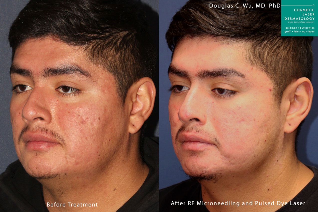 62093acne-scars.jpeg